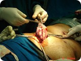 Lap Kidney surgery